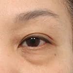 上眼睑提拉
