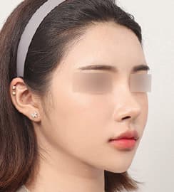 术后 3 个月