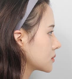 术后 3 个月