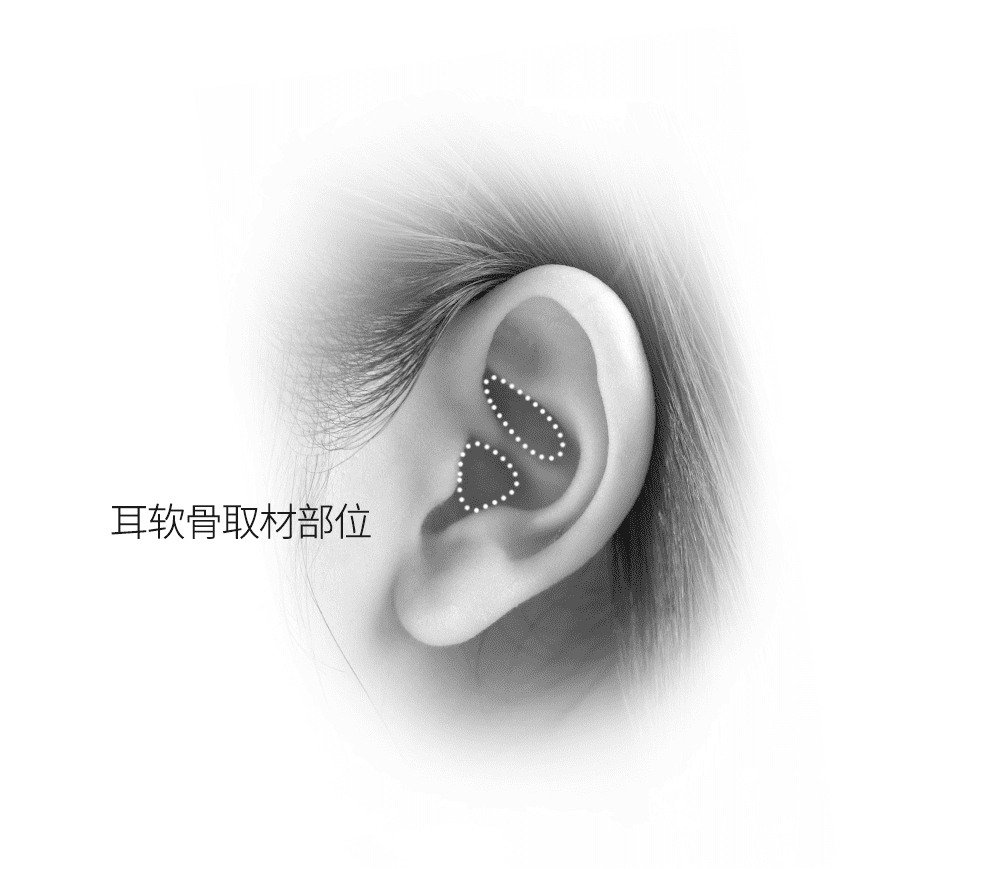 耳软骨采集