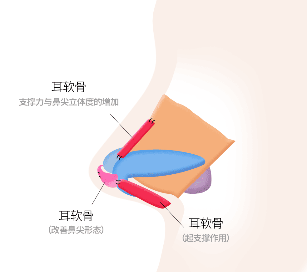 利用耳软骨矫正鼻尖、鼻梁与鼻支撑