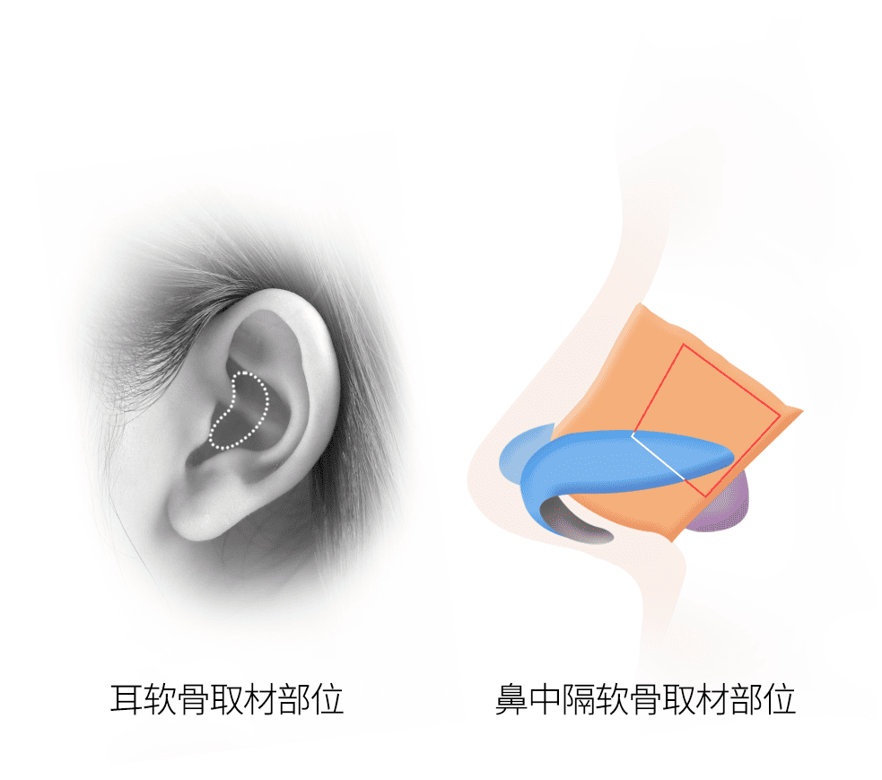 耳软骨与鼻中隔软骨采集