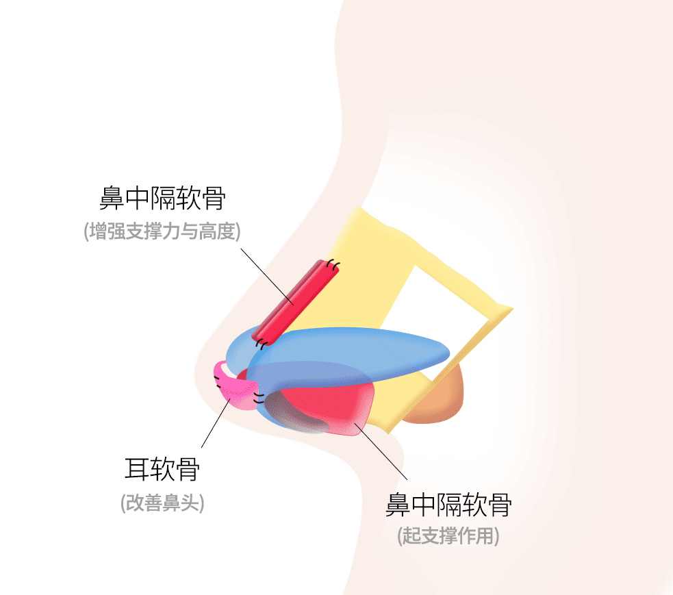 利用耳软骨与鼻中隔软骨进行矫正