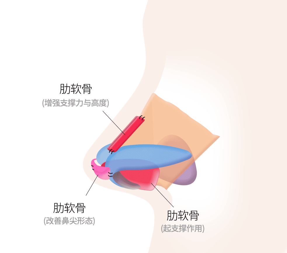 利用肋软骨进行矫正