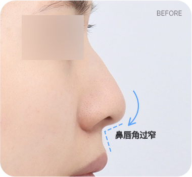 CASE 1. 鼻唇角过窄 before