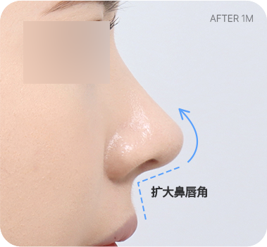 CASE 1. 鼻唇角过窄 after