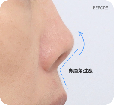 CASE 2. 鼻唇角过宽 before