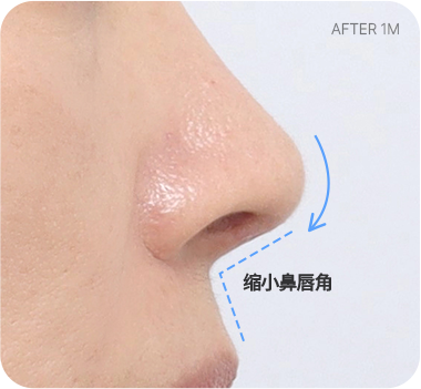 CASE 2. 鼻唇角过宽 after