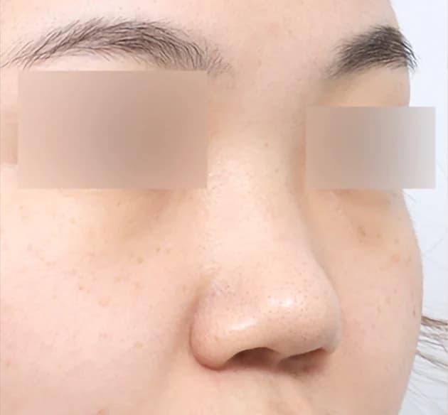 自然的鼻梁 before