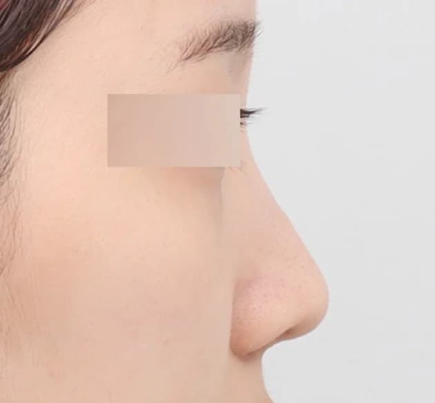 精致定制鼻部线条 before
