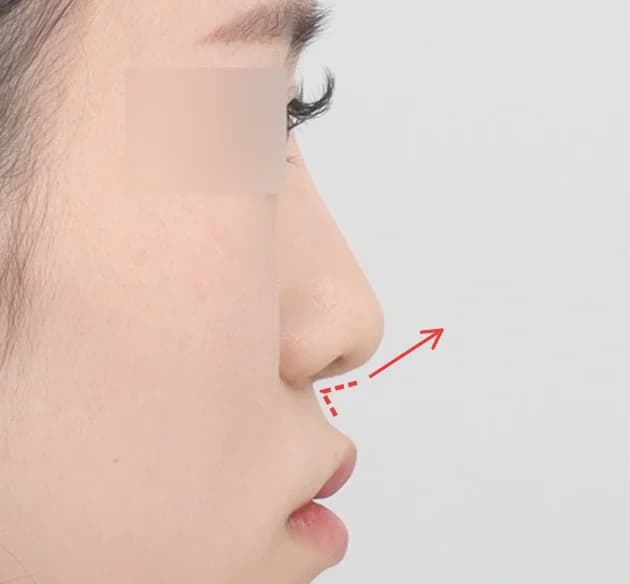高级立体感的鼻唇角 before