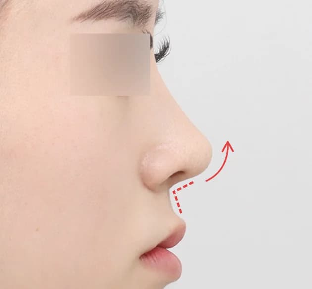 高级立体感的鼻唇角 after