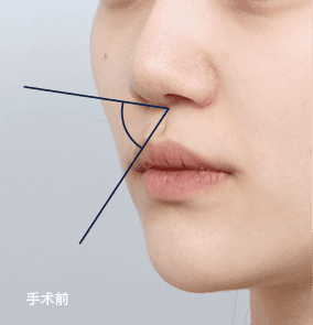鼻柱凹陷，侧面呈现凹陷感
