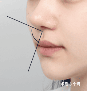 鼻柱与人中角度和谐，侧面线条流畅