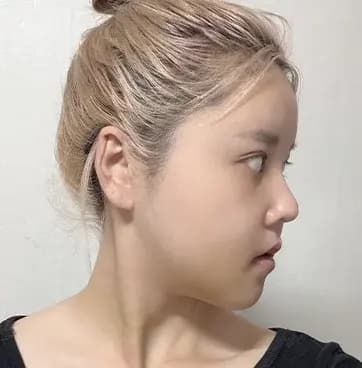 术后第12天