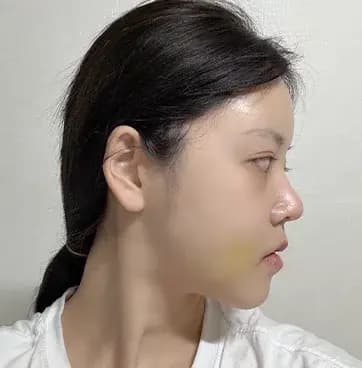 术后第14天