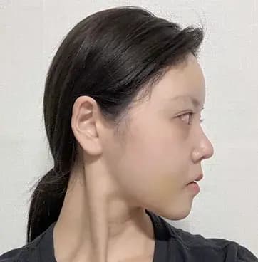 术后4周