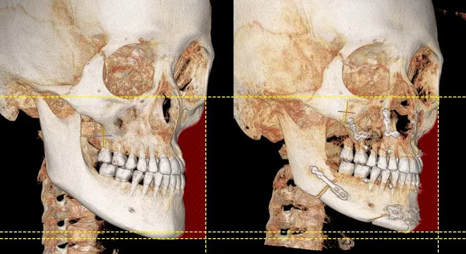 Orthognathic surgery before and after comparison