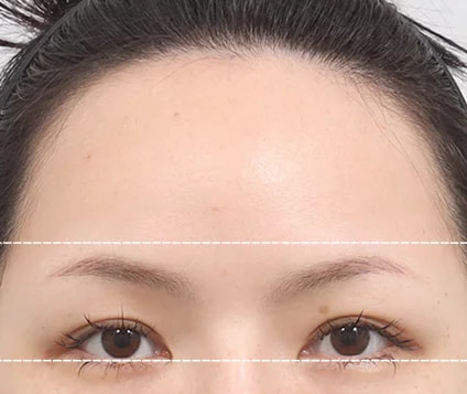 Before and After