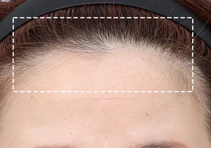 Before and After