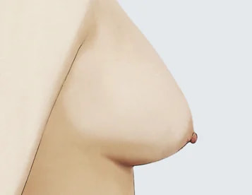 1级（轻度下垂）