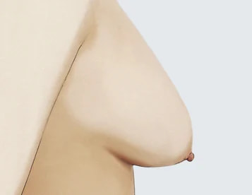 2级（中度下垂）