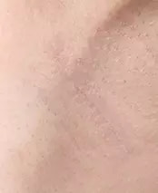 2个月后腋下部位