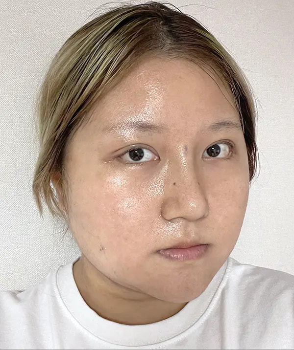术后7天