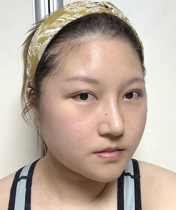 术后14天