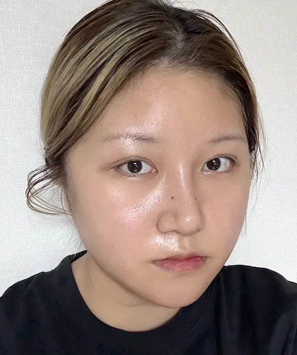 术后21天