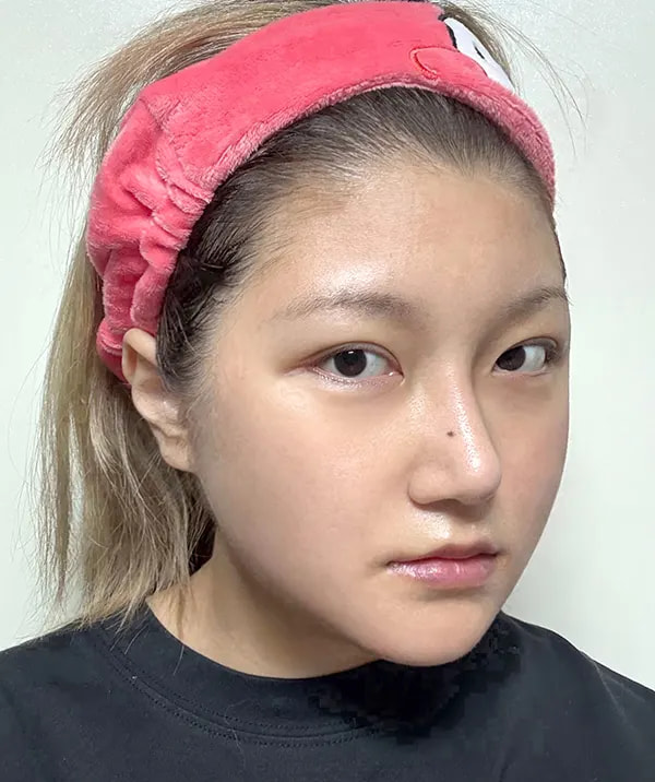 术后30天