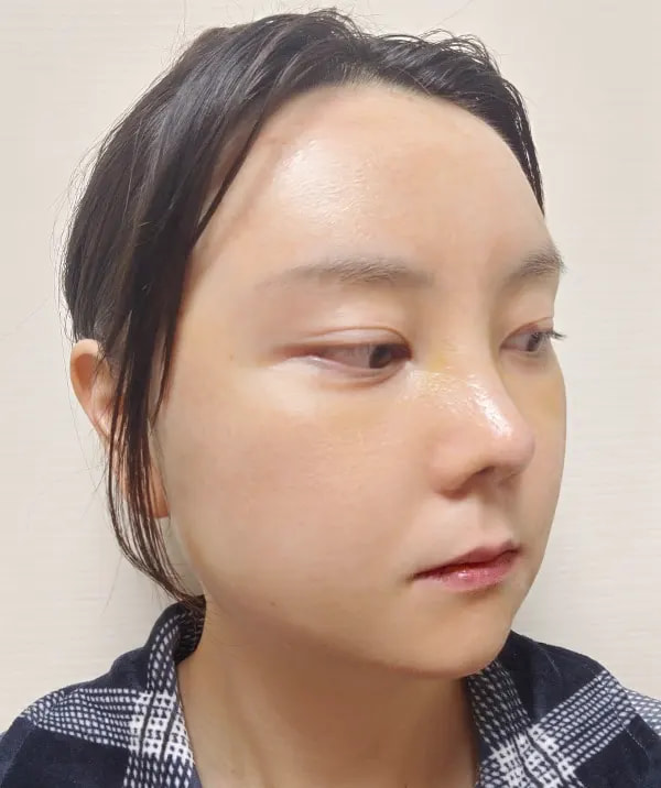 术后7天