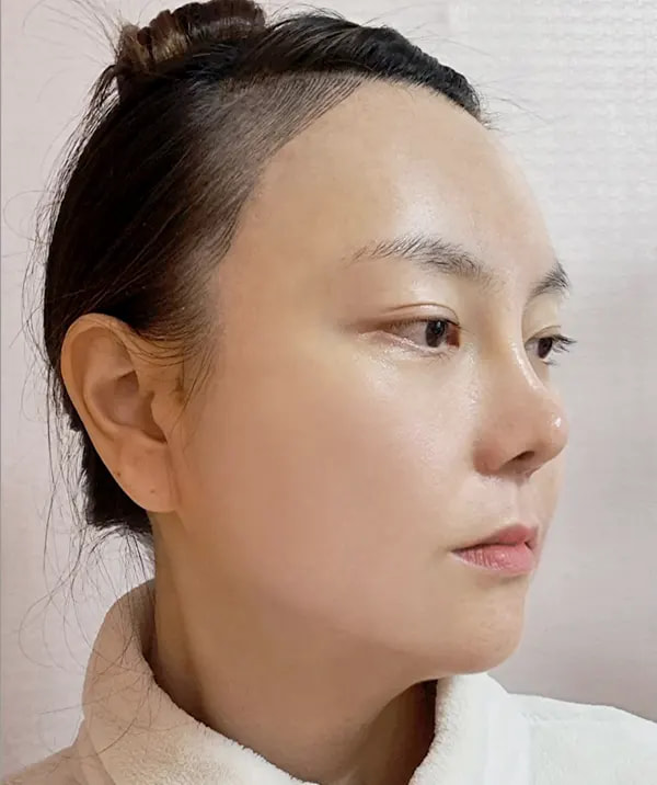 术后30天