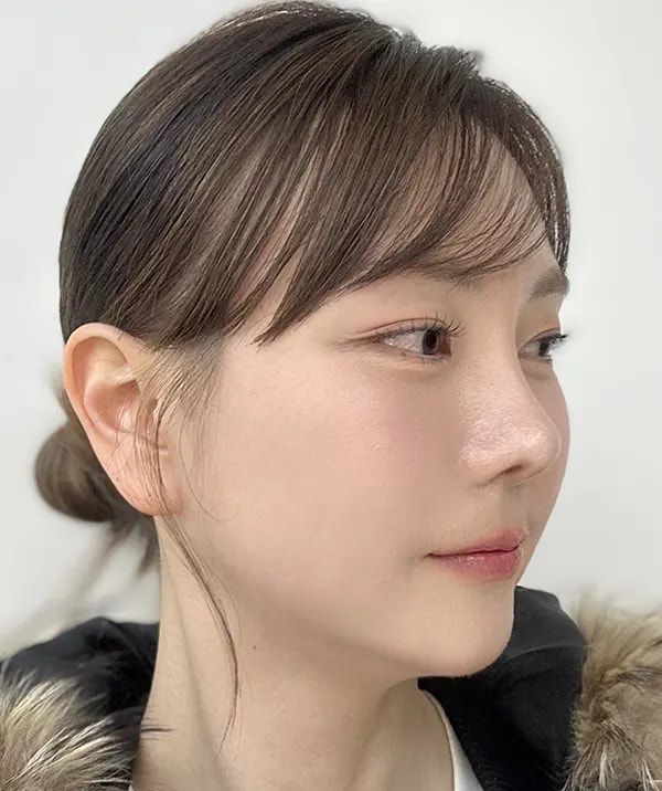 术后75天
