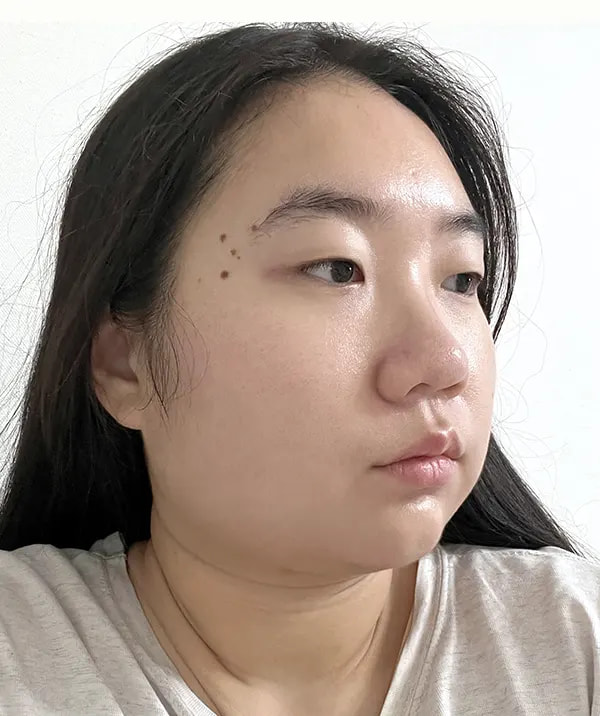 手术前