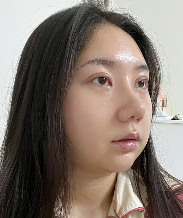 术后14天