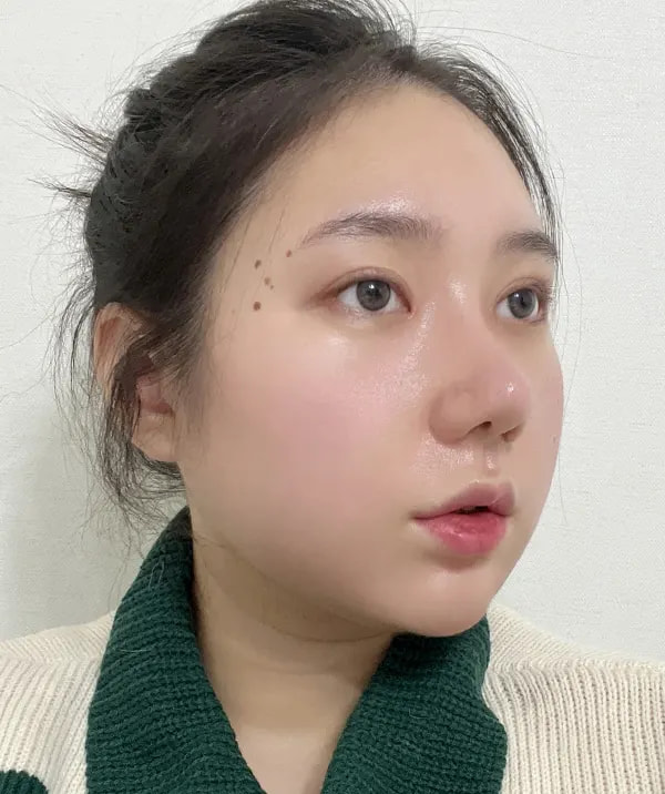 术后30天