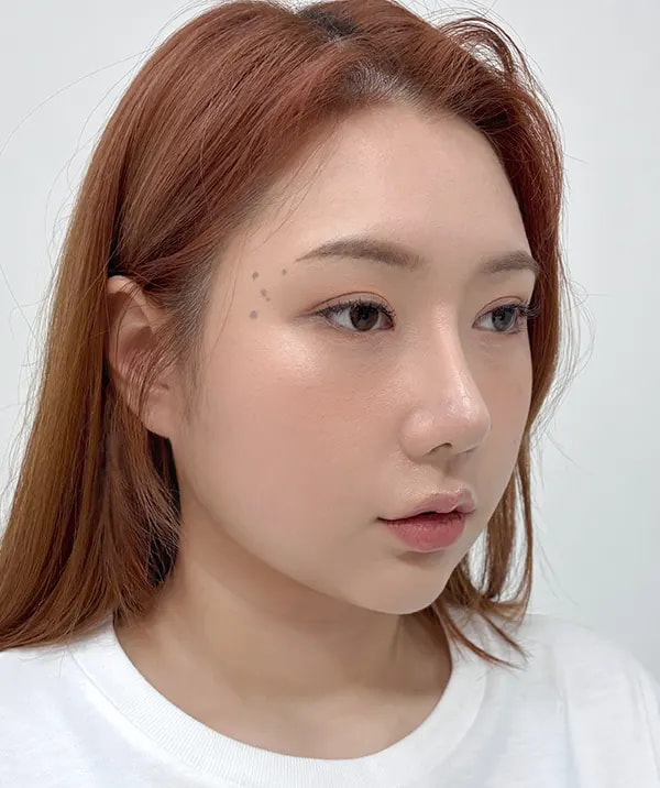 术后74天