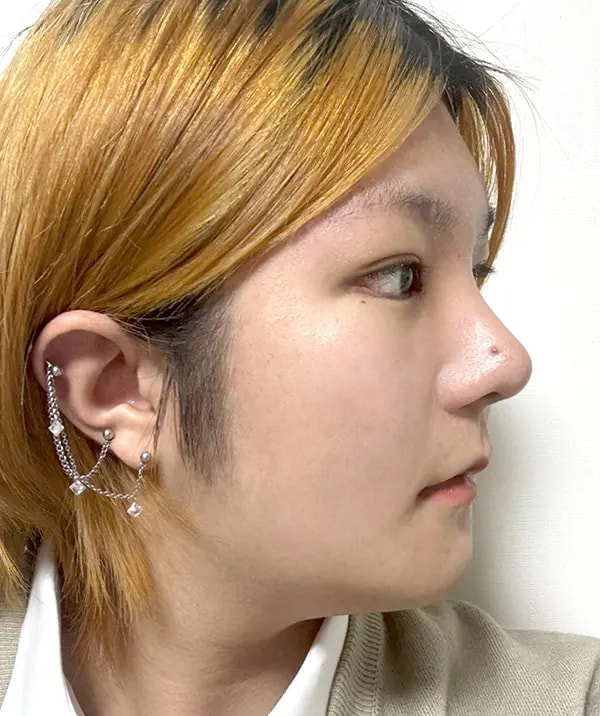 术后14天