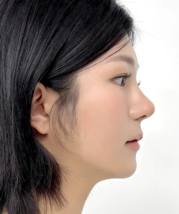 术后64天