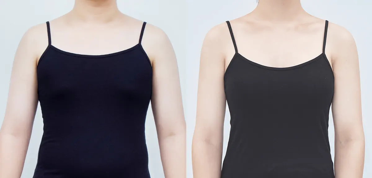 Before and after surgery