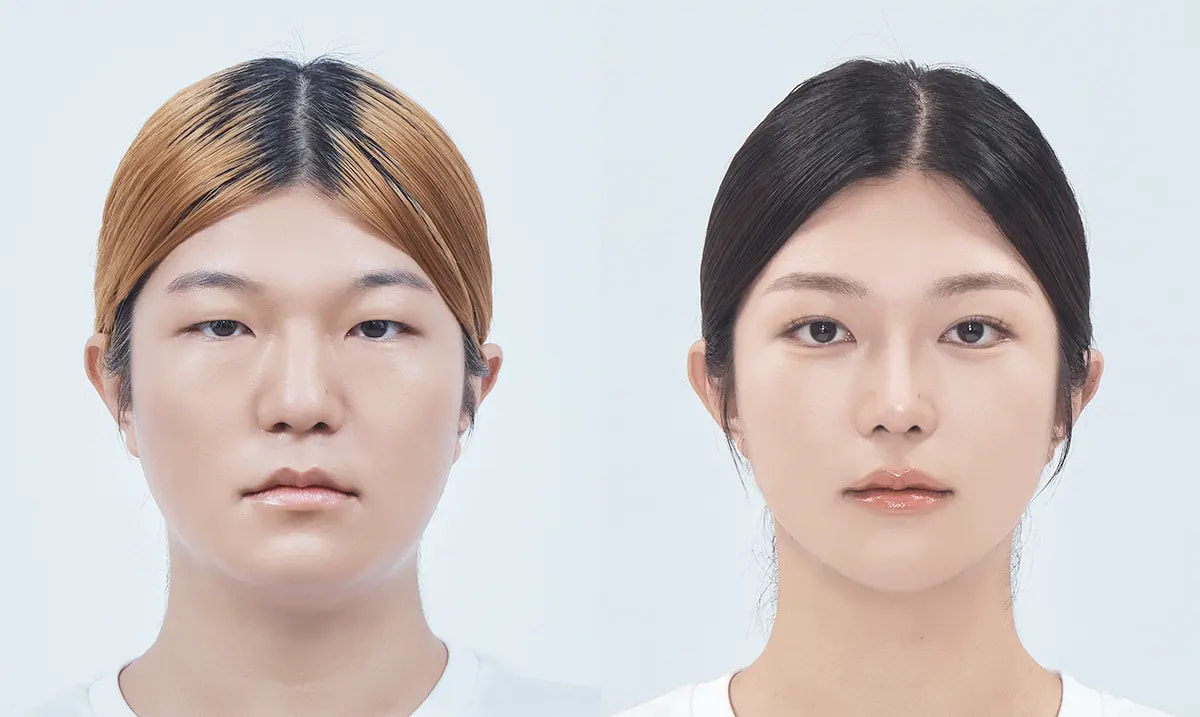 Before and after surgery