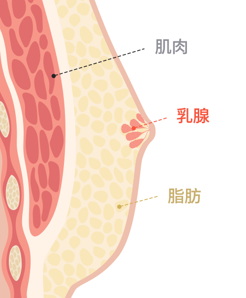 Gynecomastia surgery
