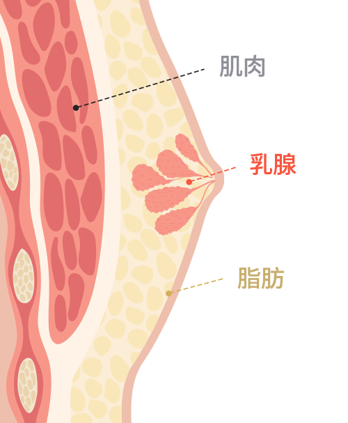 Gynecomastia surgery