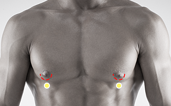 Gynecomastia surgery