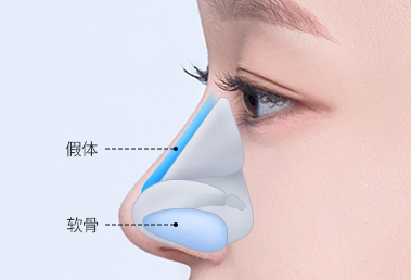 驼峰鼻整形 — step 2