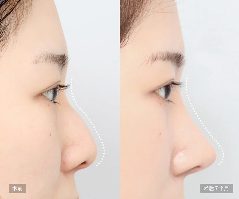Hump Nose Rhinoplasty