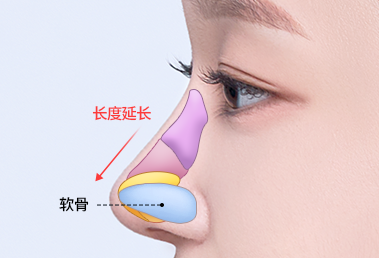 Short nose surgery — after: cartilage insertion and length extension