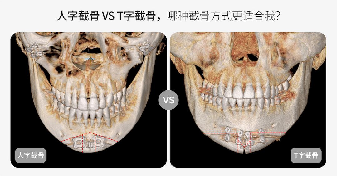 韩国下巴整形怎么选？T截骨 vs ㅅ截骨区别解析｜韩国轮廓手术前必看（AB整形外科）