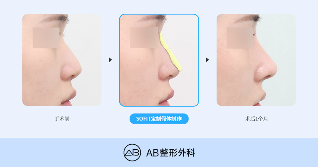 SOFIT 3D定制假体鼻整形与普通鼻整形有什么区别？哪些情况适合定制假体？
